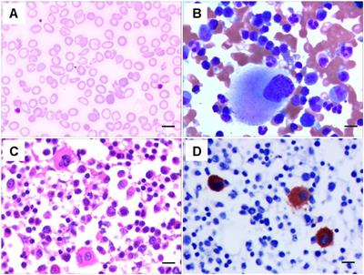 A Rare Big Chinese Family With Thrombocytopenia 2: A Case Report and Literature Review